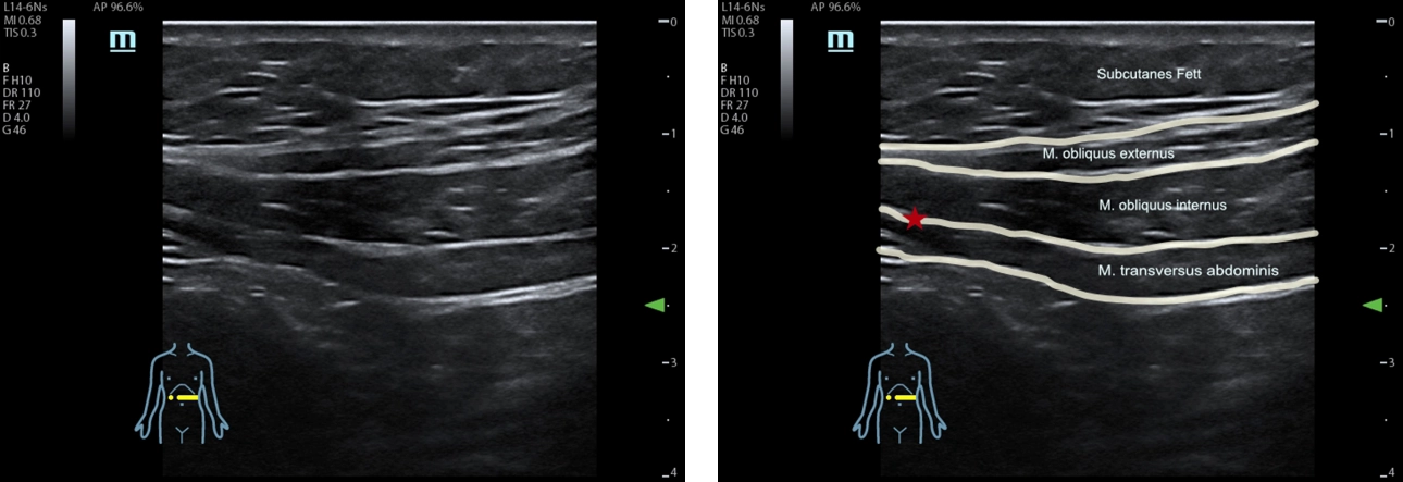 ultrasound-controlled-fig1-pc