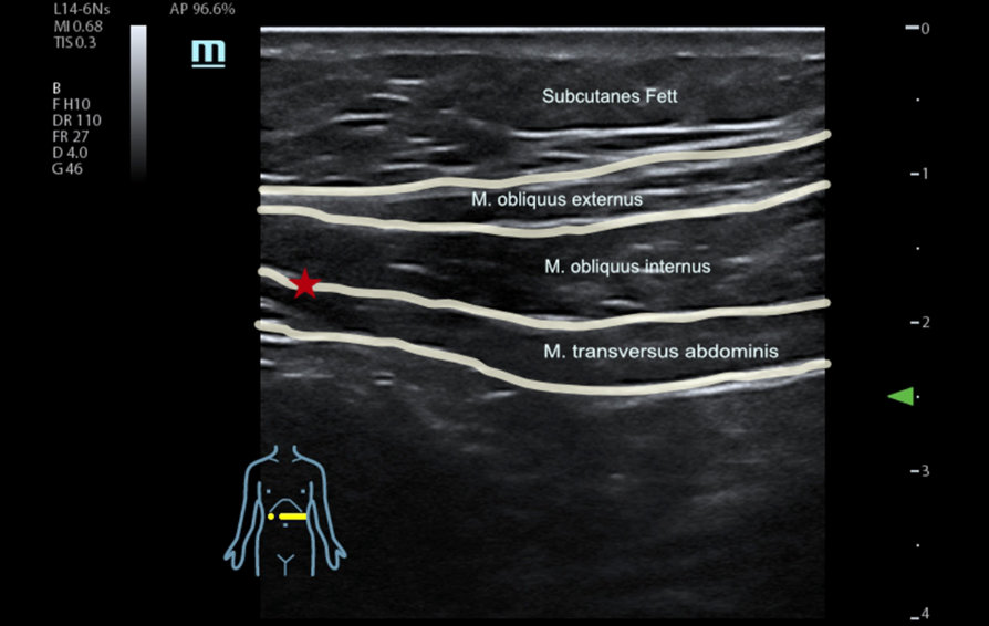 ultrasound-controlled-kv-pc