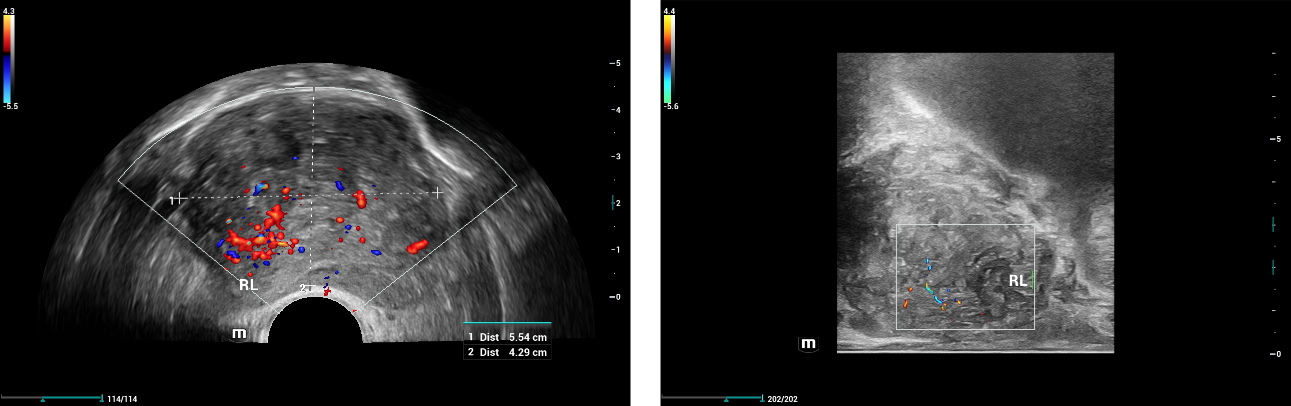 prostate-shearwave-fig1-pc