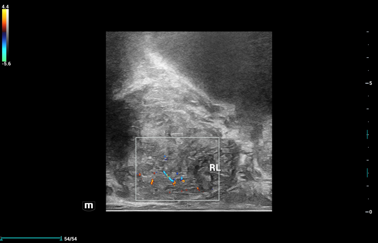 prostate-shearwave-fig3-pc