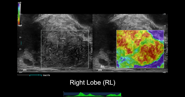 prostate-shearwave-fig4-pc