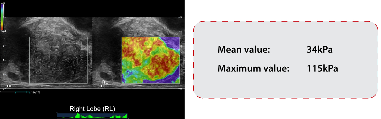 prostate-shearwave-fig6-pc