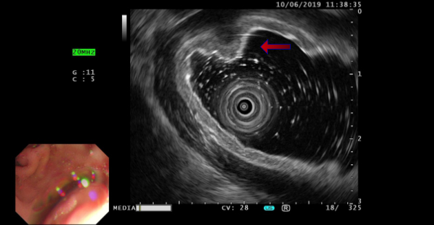 ectopic-pancreas-fig2-pc