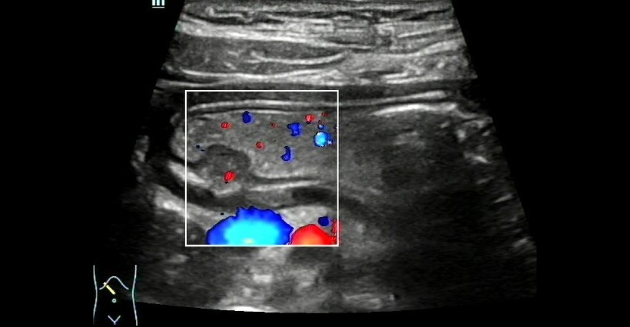 ectopic-pancreas-fig4-pc