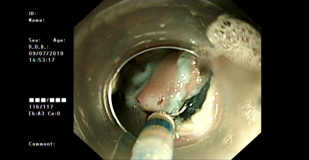 ectopic-pancreas-fig5-pc