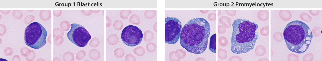 hemablog-1-aml-m4-fig5-pc