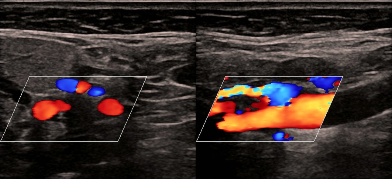 carotid-glomus-fig1-pc