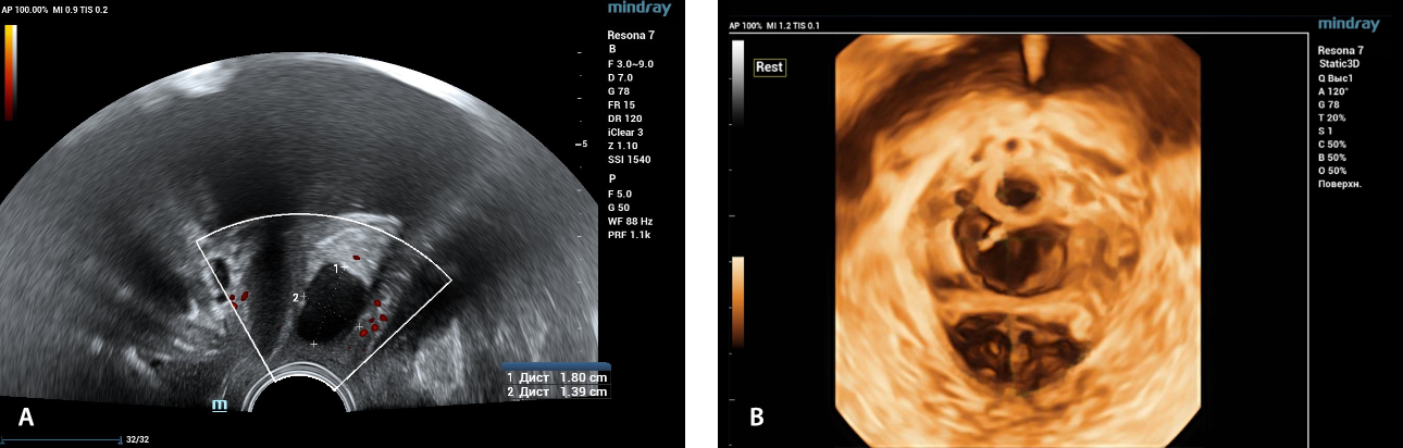 endometrioid-cyst-fig2-pc