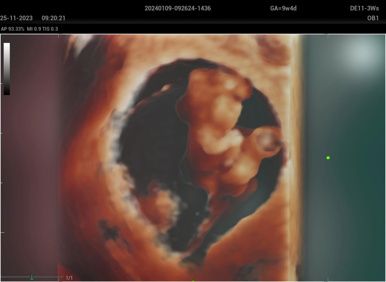 Fetus of 9w in 3D mode, using the virtual light rendering iLive Pro by Mindray