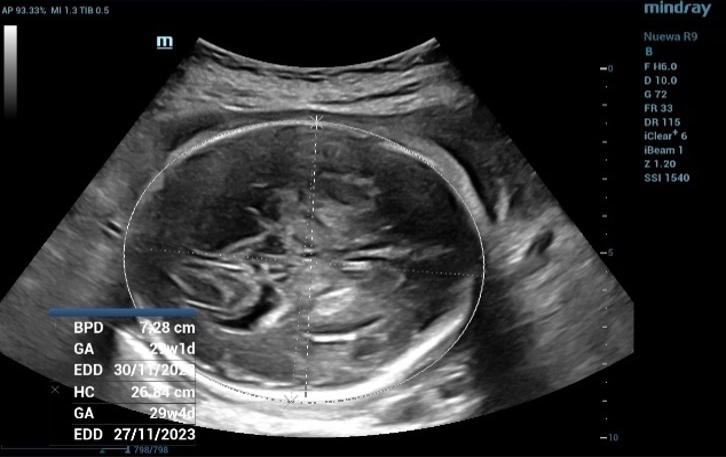 Fetal Head Biometric Measurements: Biparietal Diameter (BPD)