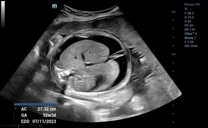 Fetal Biometric Measurements: Abdominal Circumference (AC) 