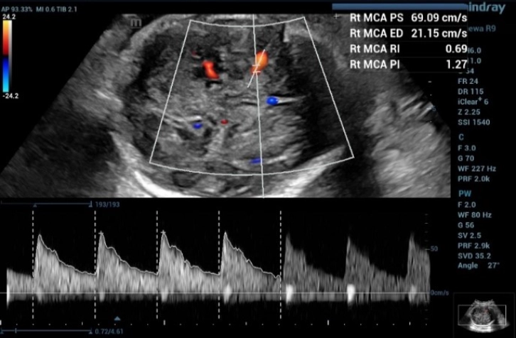 the first measurement of the doppler waveform of MCA in fetus with and the MCA-PSV value was 69.09 cm/s, which is greater than 1.55 MoM 