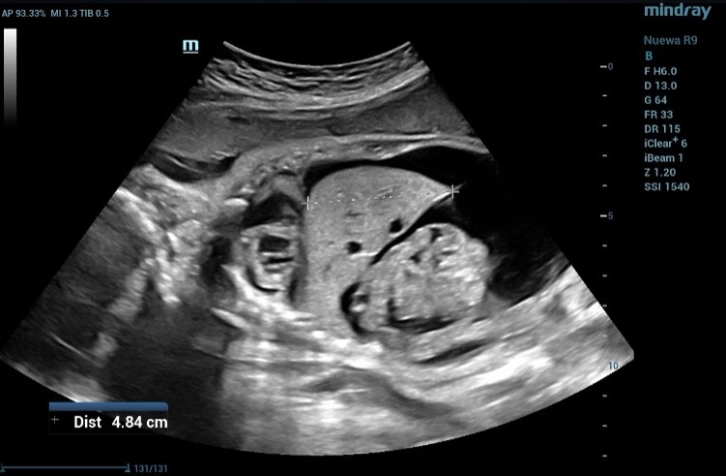 the measurement of the liver