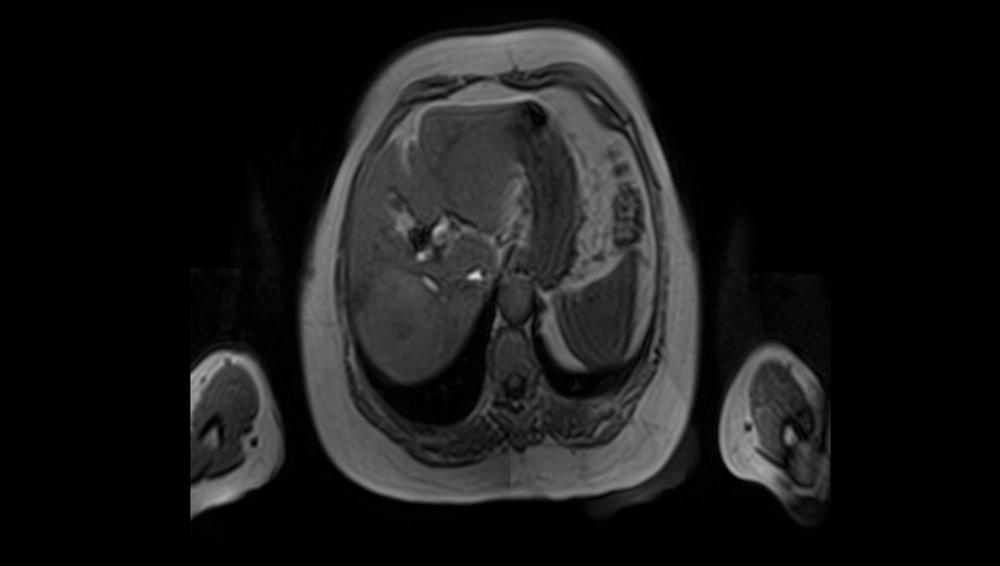 non-crirrhotic-liver-fig1