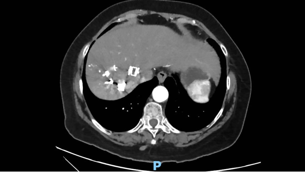 non-crirrhotic-liver-fig2