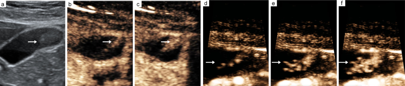 ceus-gallbladder-adenoma-fig2-pc