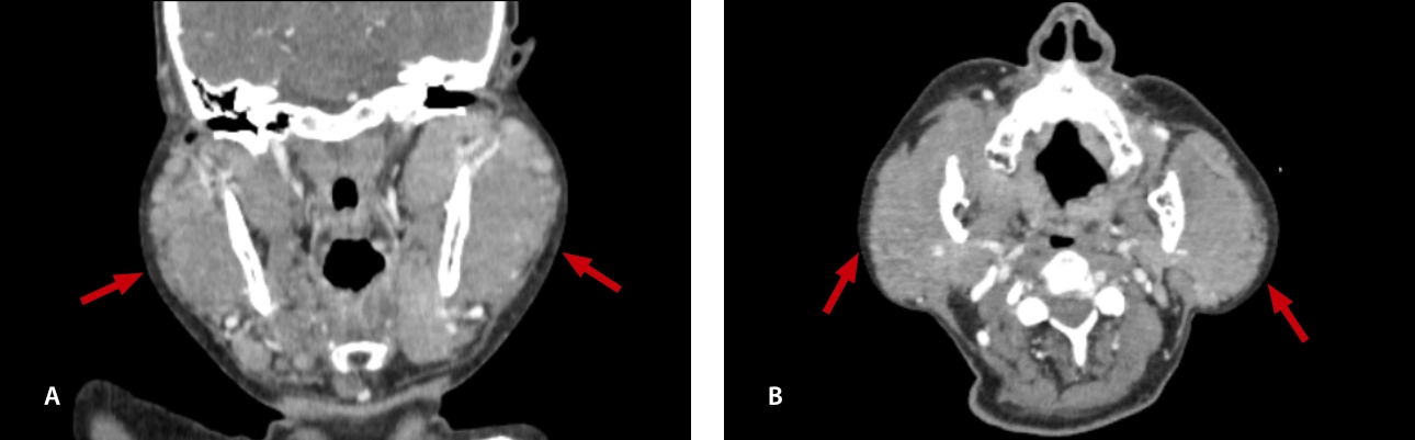 lymphoma-simulator-fig7-pc