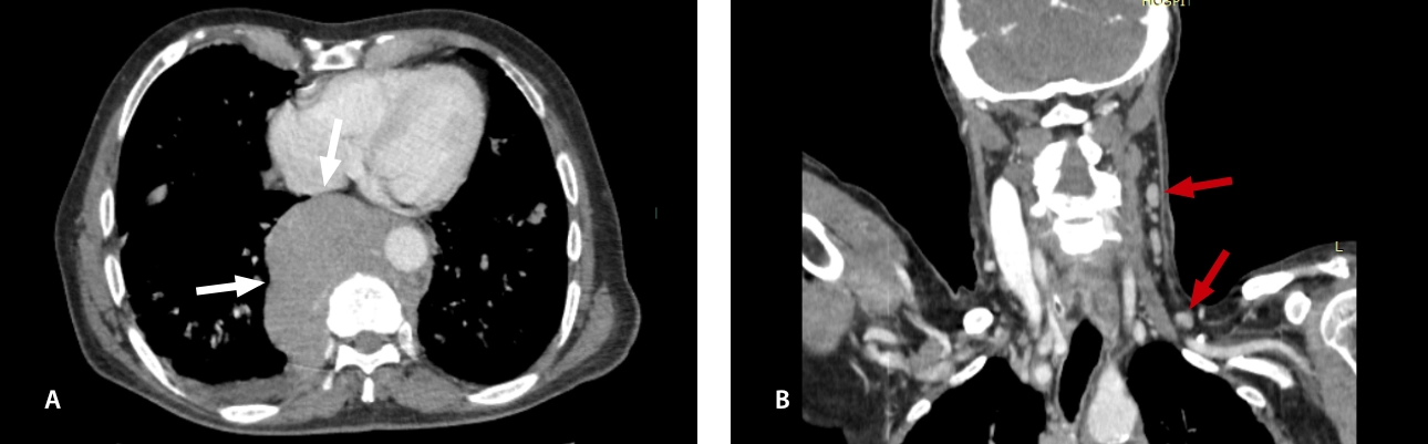 lymphoma-simulator-fig9-pc