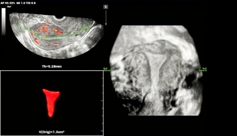 Use of Smart ERA in diagnosis of Mullerian duct abnormalities - Normal uterus