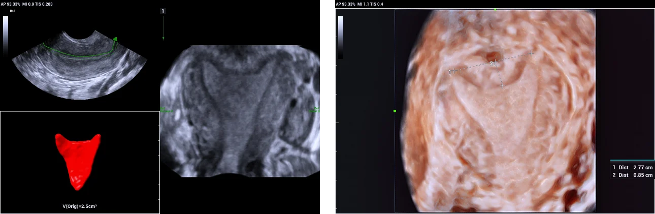 Use of Smart ERA in diagnosis of Mullerian duct abnormalities - Arcuate uterus