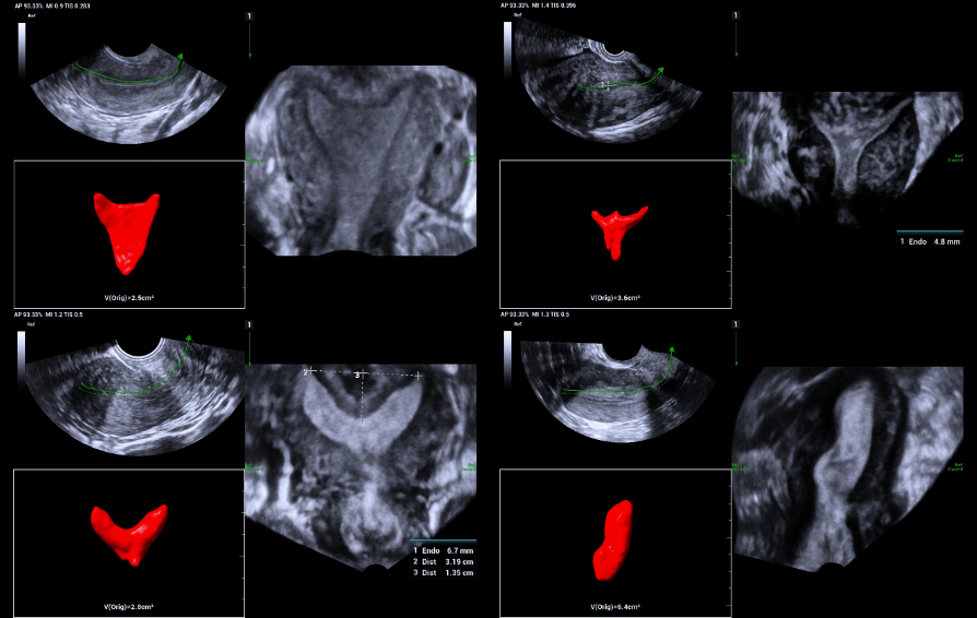 mullerian-duct-abnormalities-kv-pc