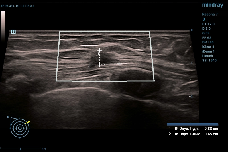 multiparametric-breast-mass-fig2