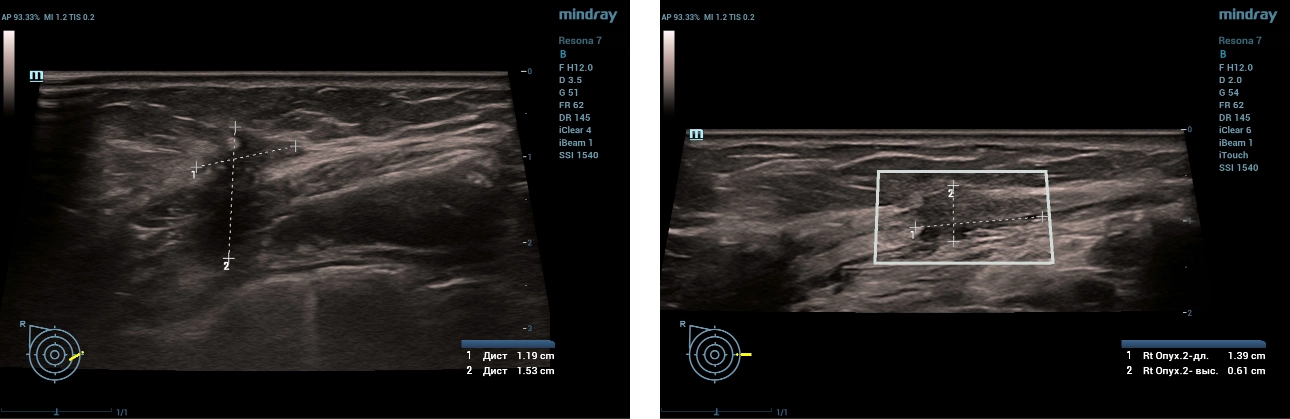 multiparametric-breast-mass-fig4-pc