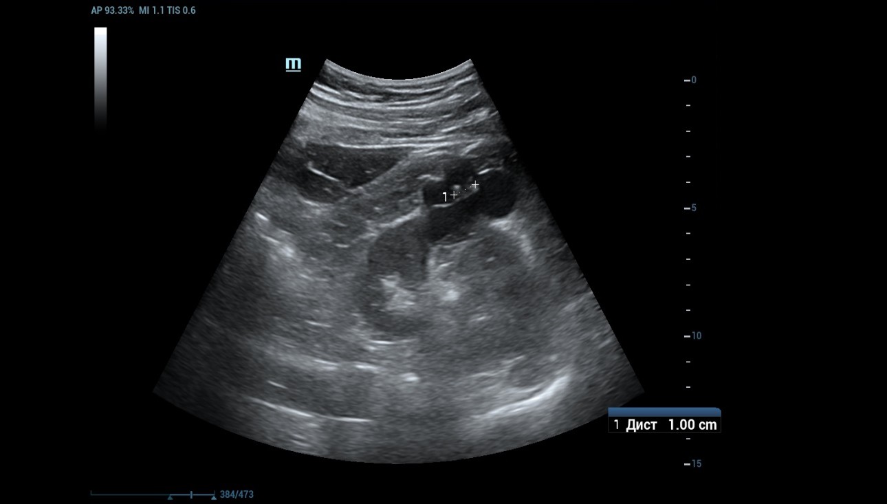 complex-cystic-renal-mass-fig2-pc