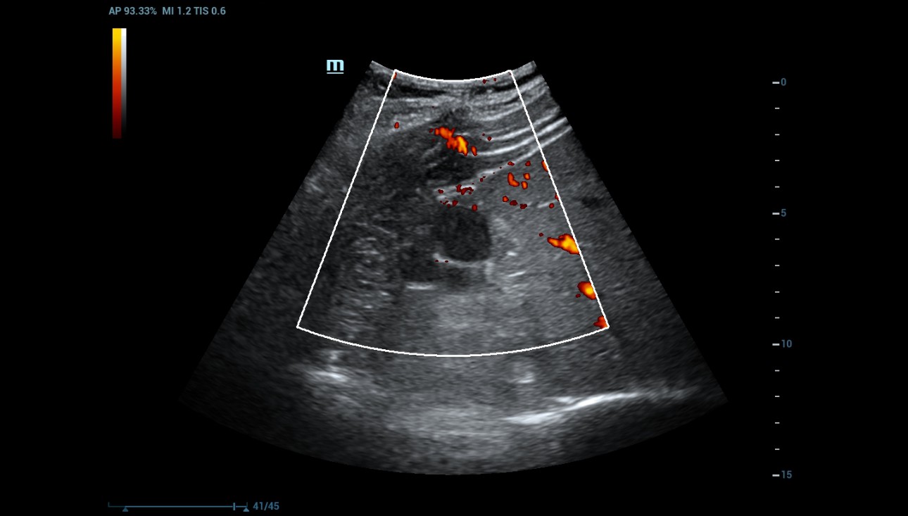 complex-cystic-renal-mass-fig3-pc