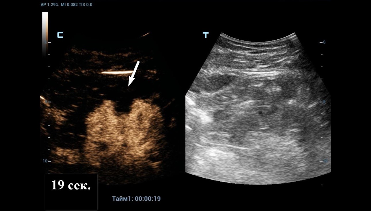 complex-cystic-renal-mass-fig4-pc