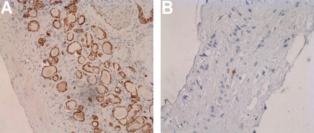 complex-cystic-renal-mass-fig7-pc