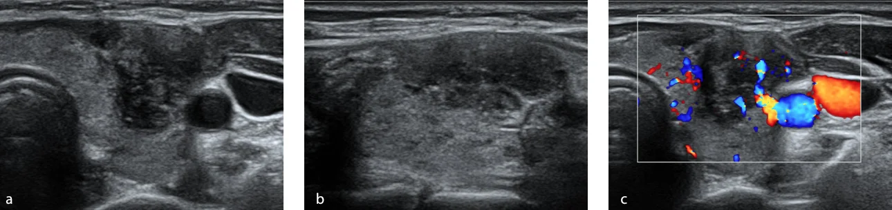 Fig. 1. US in grayscale axial section (a) and sagittal (b) shows a nodule in the middle third of the left thyroid lobe, solid, hypoechoic, wider than high, with apparent extrathyroid extension and pointed echogenic foci, measures approximately 1.3 x 1.3 x 2.1 cm, evaluated as ACR TI-RADS 5. At the application of color Doppler (c) shows internal vascularity.