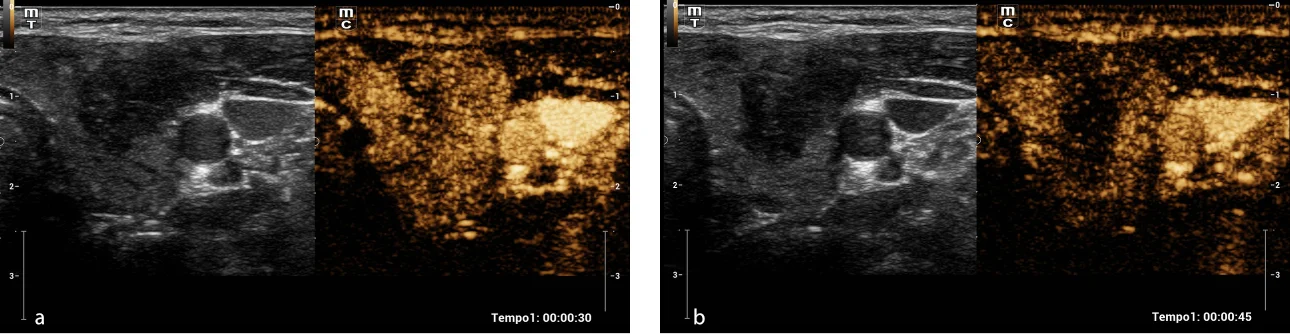 Fig. 3. Contrast ultrasound (CEUS). Heterogeneous iso-enhancement of the thyroid nodule (a) is observed with early wash-out with respect to the thyroid parenchyma adjacent at 45 s (b).