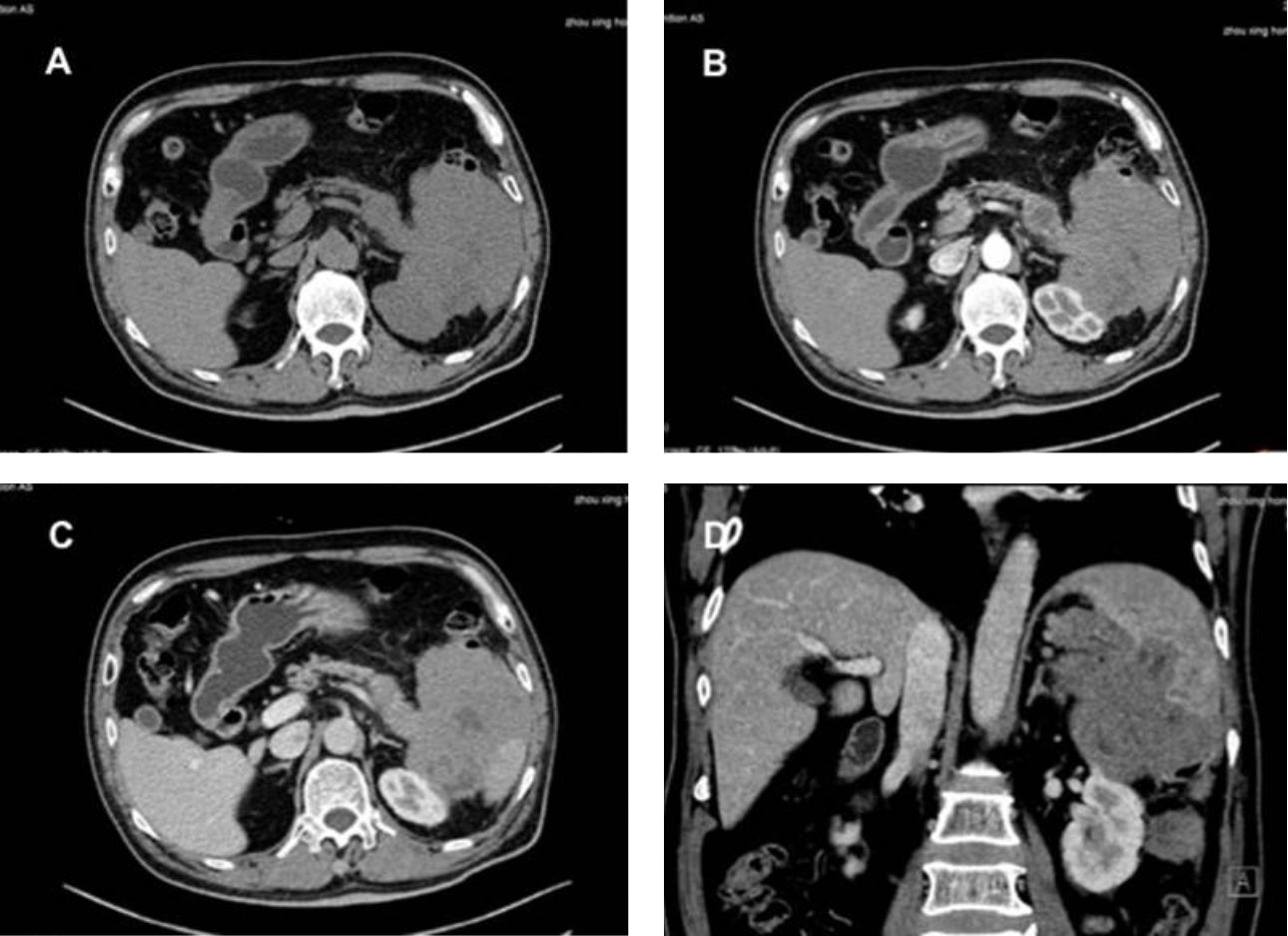 pancreatic-lymphoma-fig2-pc