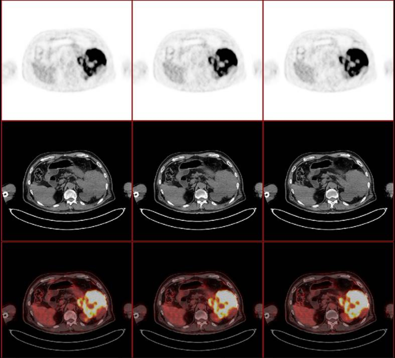 pancreatic-lymphoma-fig3-pc