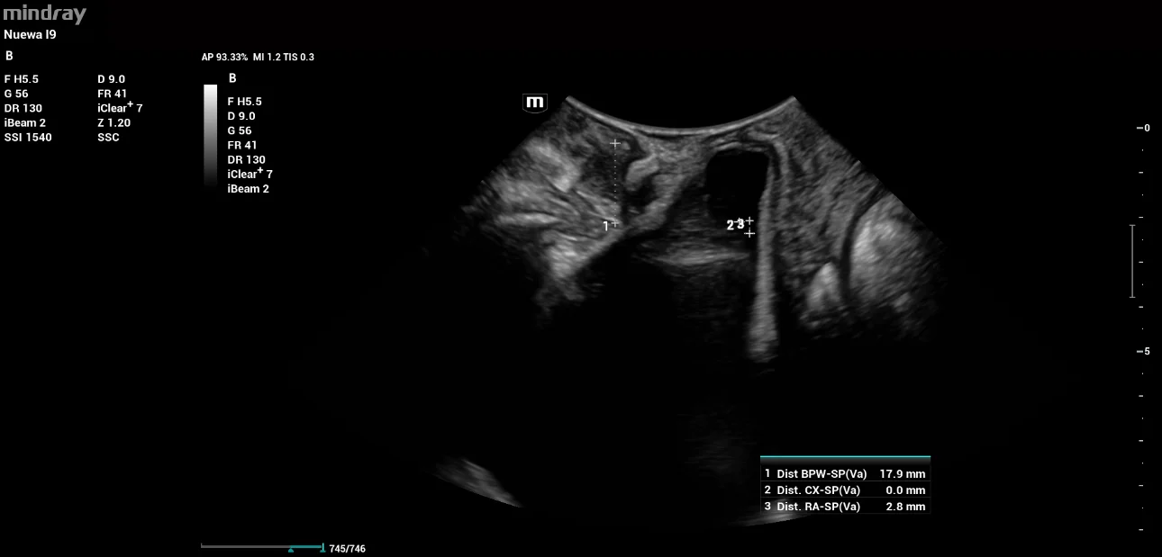 pelvic-floor-ultrasound-stress-incontinence-fig3