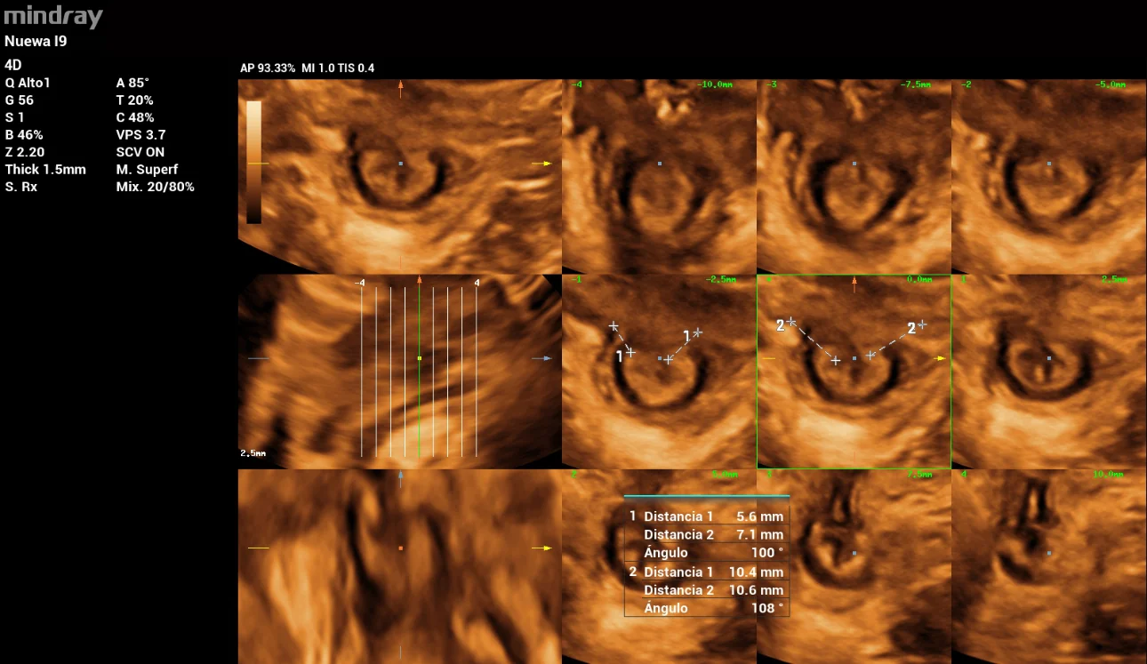 pelvic-floor-ultrasound-stress-incontinence-fig6