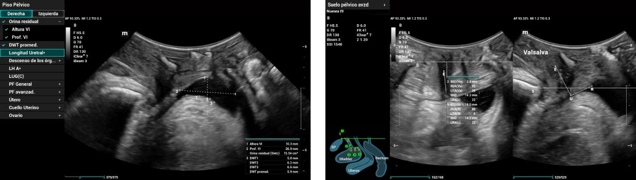 pelvic-floor-ultrasound-stress-incontinence-fig7