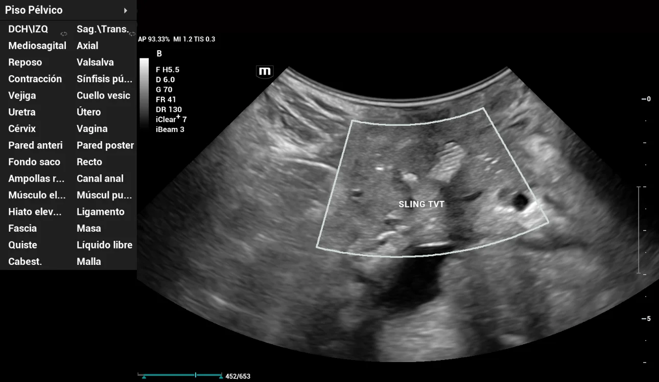 pelvic-floor-ultrasound-stress-incontinence-fig8