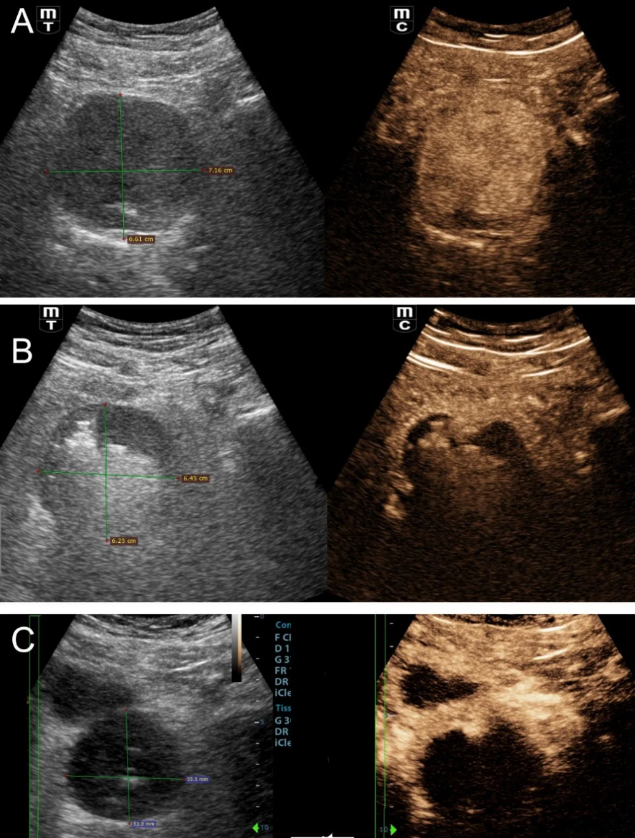 prostatic-artery-embolization-fig1-pc