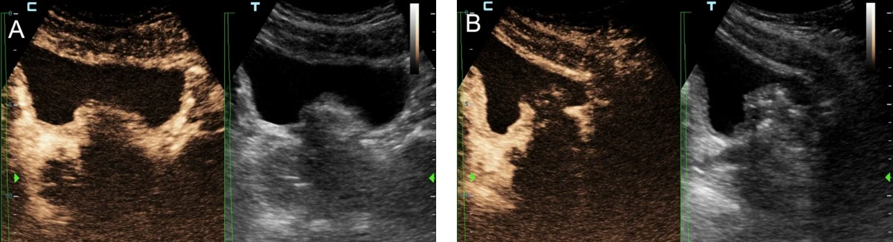 prostatic-artery-embolization-fig2-pc