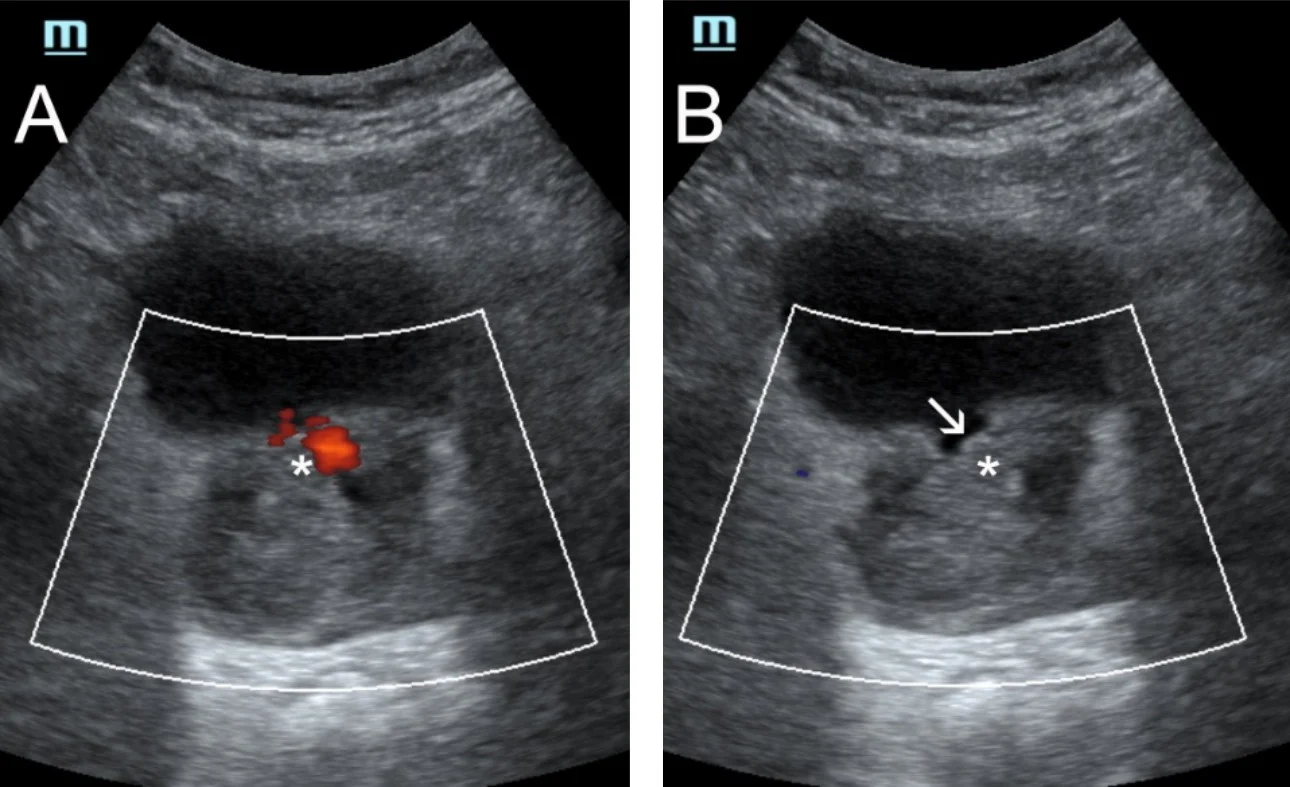 prostatic-artery-embolization-fig4-pc