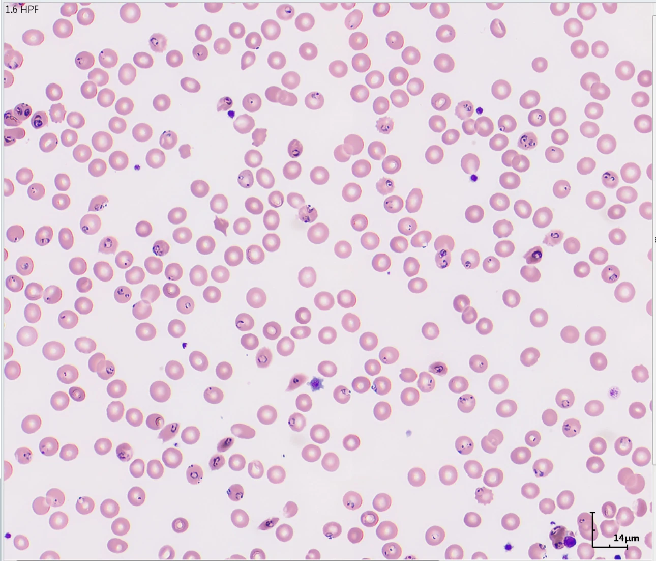 thrombocytopenia-fig3