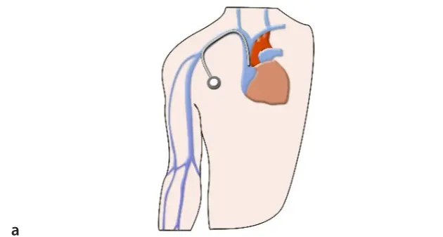 subcutaneous-venous-port-fig1-1