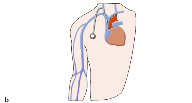 subcutaneous-venous-port-fig1-2