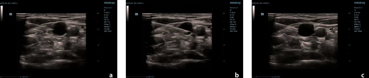 subcutaneous-venous-port-fig3-pc