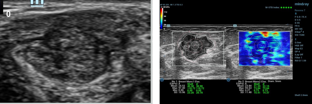 swe-prior-breast-mass-fig1-pc