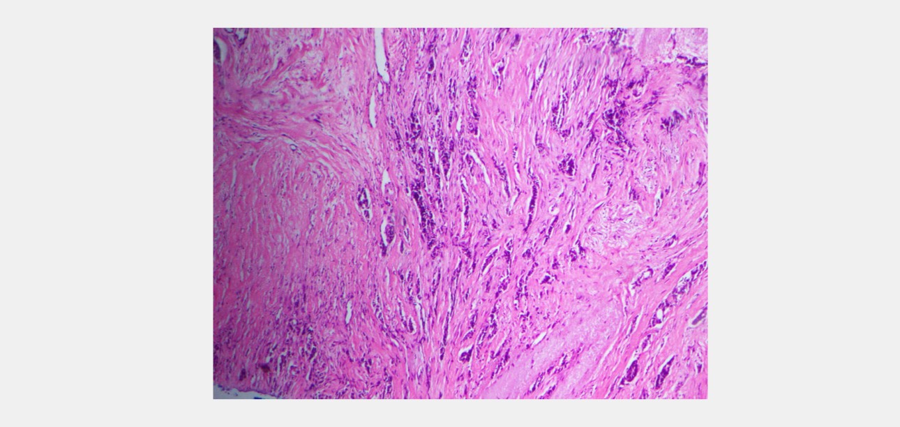 swe-prior-breast-mass-fig2-pc