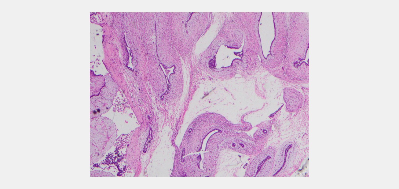 swe-prior-breast-mass-fig4-pc