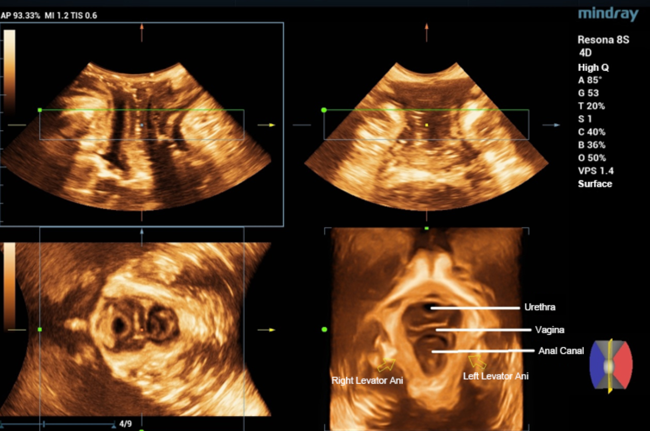 levator-trauma-fig3-pc